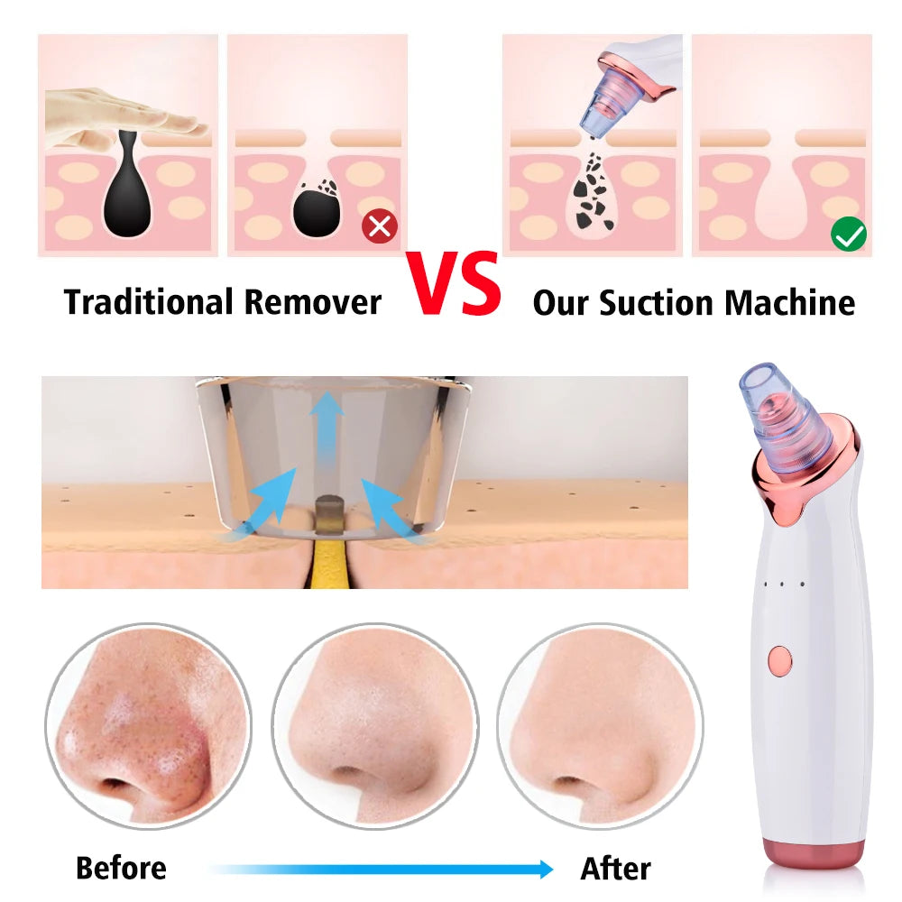 Electric Suction Blackhead Remover