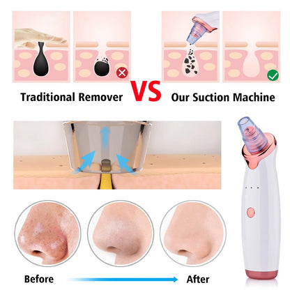 Electric Suction Blackhead Remover